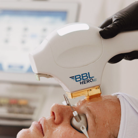 BBL HEROic Photofacial