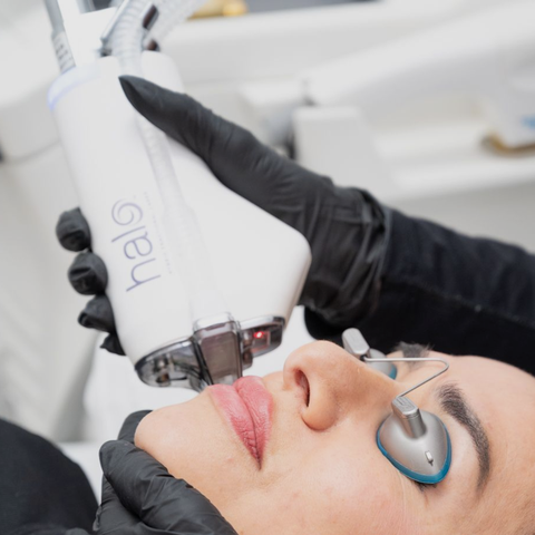 HALO® Fractional Laser Resurfacing