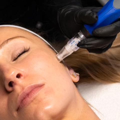 SkinPen® Microneedling With PRP