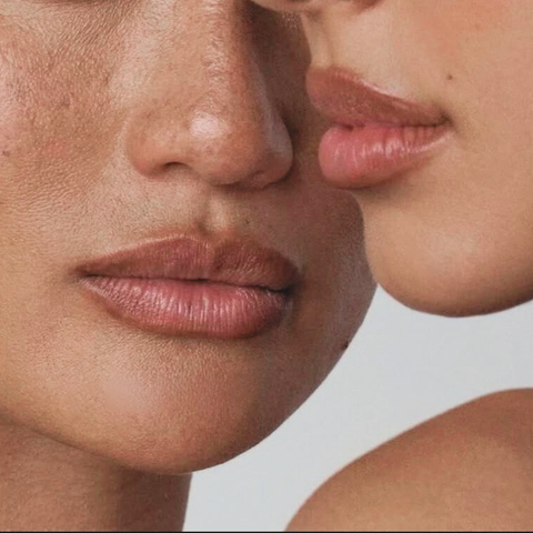 Restylane® Refyne