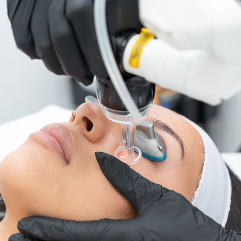 AcuPulse™ CO2 Laser Resurfacing