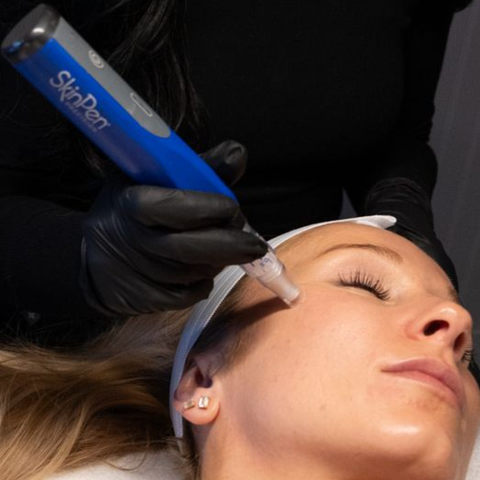 SknPen Microneedling